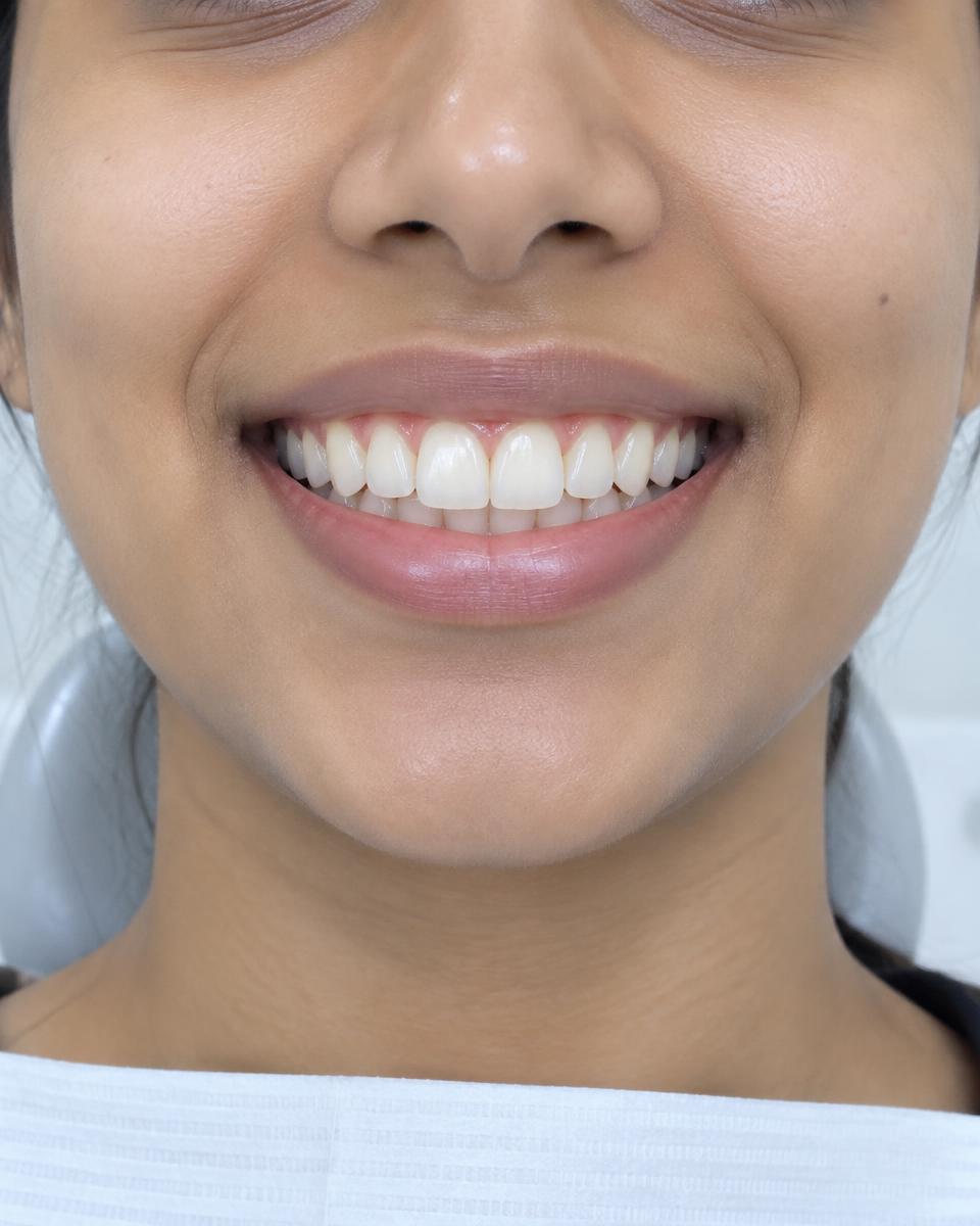 Demo smile alignment example after treatment